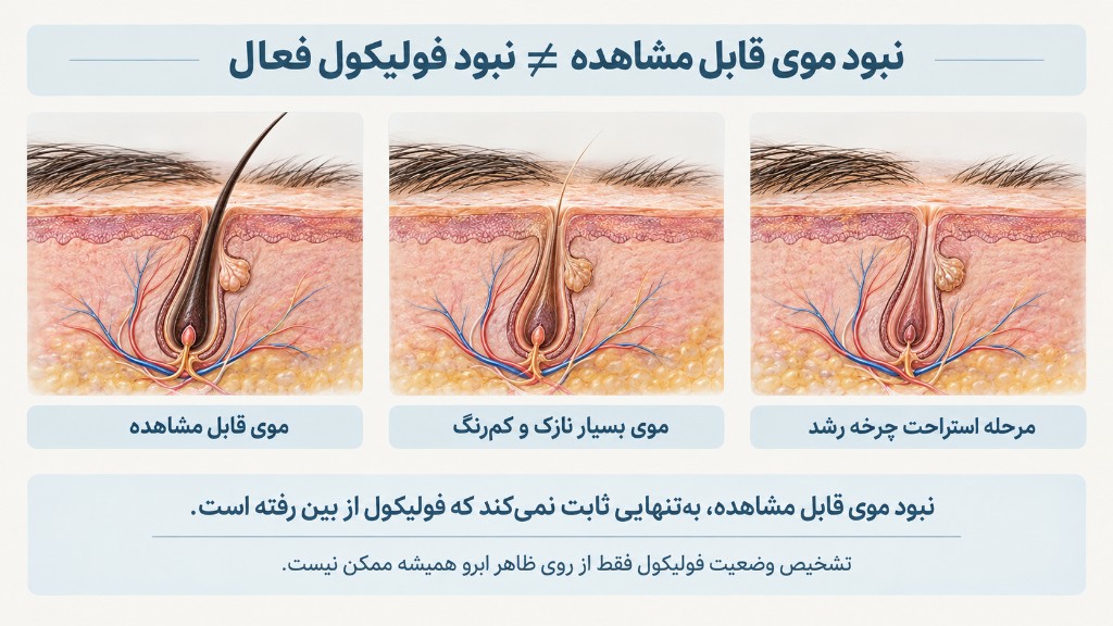 نبود موی قابل مشاهده به معنای نبود فولیکول فعال نیست