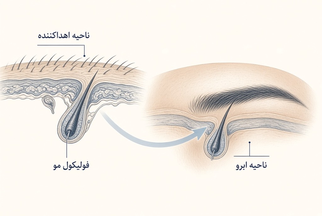 انتقال فولیکول از ناحیه اهداکننده به ابرو در کاشت ابرو