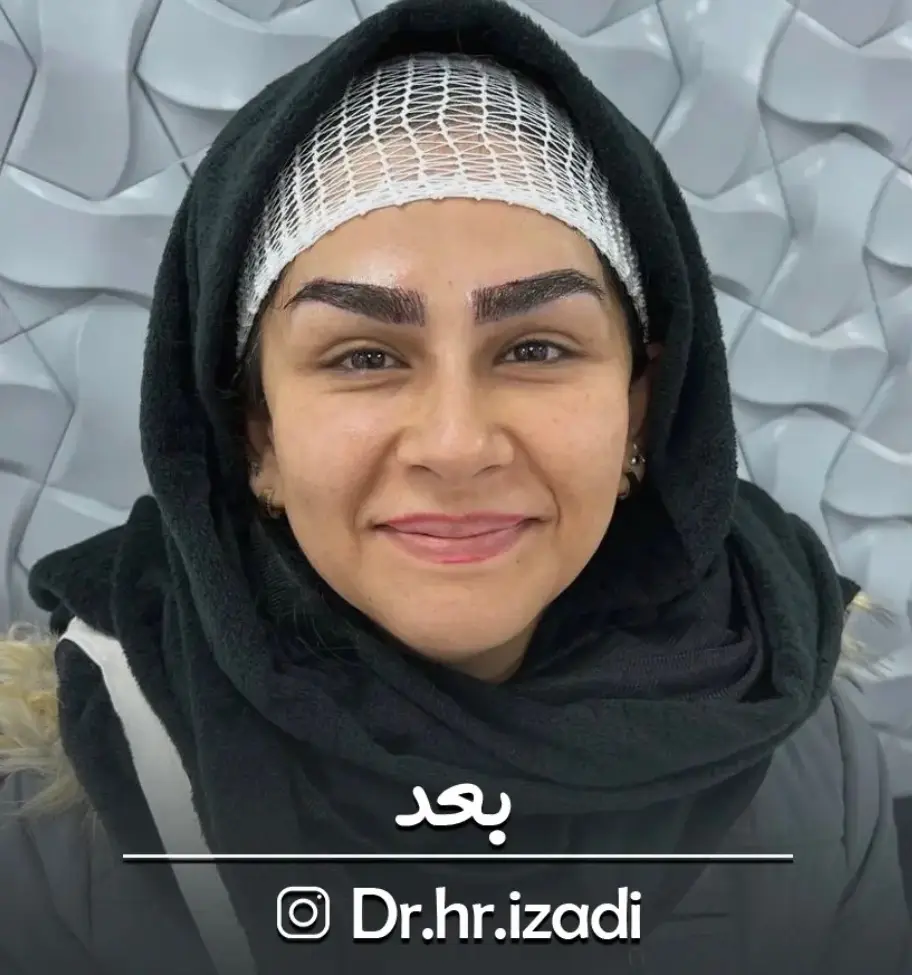 طراحی و کاشت ابرو — بعد