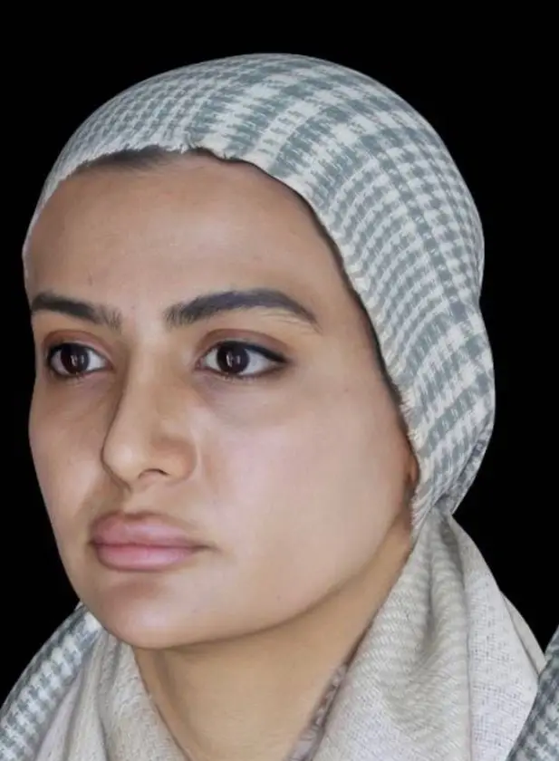 کاشت ابرو طبیعی — قبل