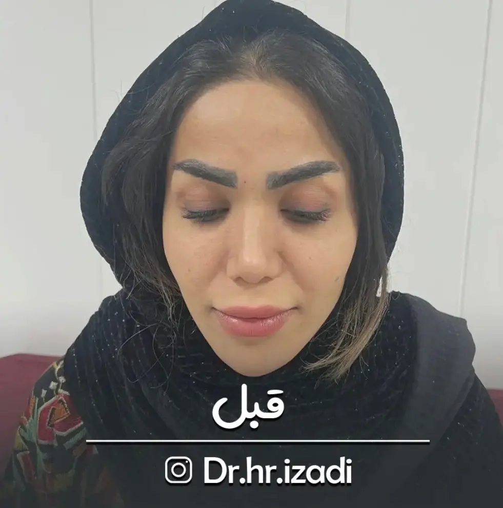 ترمیم ابرو — قبل